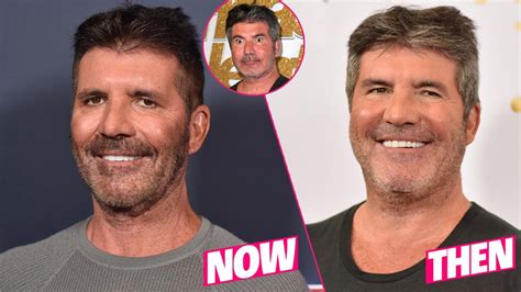 Simon Cowell Plastic Surgery Makeover Exposed By Top Docs