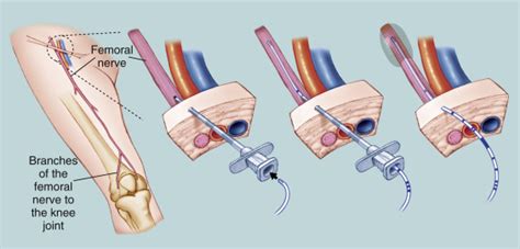 Continuous Peripheral Nerve Blocks Anesthesia Key