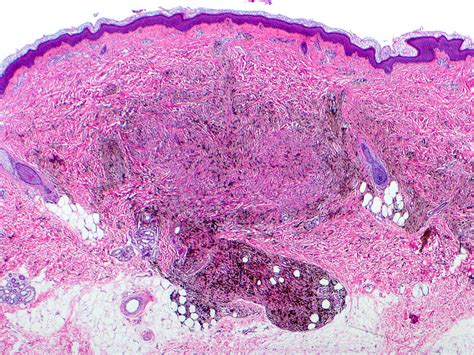 Blue Nevus Histology