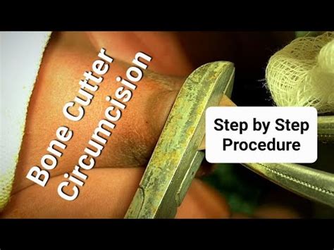 Circumcision Bone Cutter Method Step By Step With Aftercare Dr Tayyab Riaz Ch YouTube