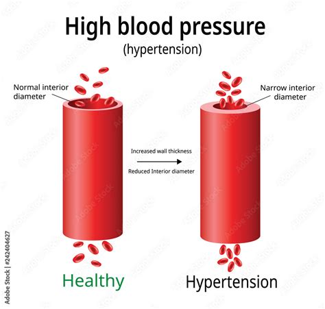 Hypertension High Blood Pressure Vector Two Blood Vessels Science
