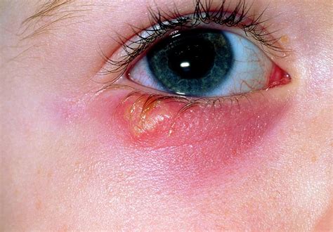 Herpes zoster ophthalmicus in olmsted county, minnesota: Herpes Simplex Blister Below Eye Of Young Girl Photograph by Dr P. Marazzi/science Photo Library