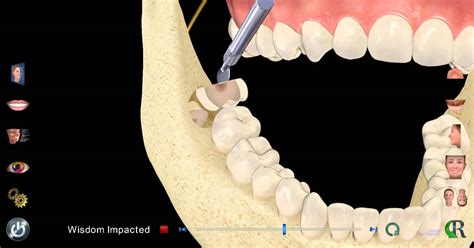 Impacted Wisdom Tooth Extraction Youtube