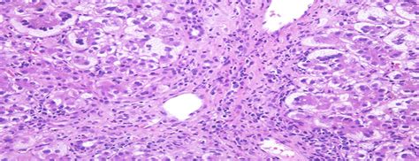 S2513 Giant Cell Hepatitis Due To Drug Induced Autoimmune He