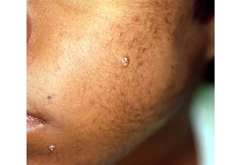 Infectious Skin Conditions Not To Miss Slideshow