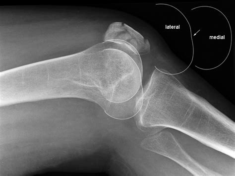 Lateral Knee Radiography Wikiradiography