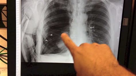 Large Pneumothorax Collapsed Lung Youtube