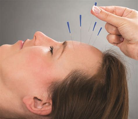 acupuncture offers more treatments and improved results for your practice