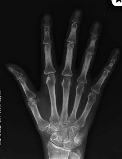 If the pattern of disease is not symmetrical, then a different diagnosis should be considered. Rheumatoid arthritis x ray - wikidoc