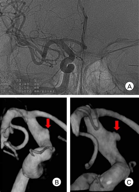 Conventional 4 Vessel Cerebral Angiography Demonstrates A Blood