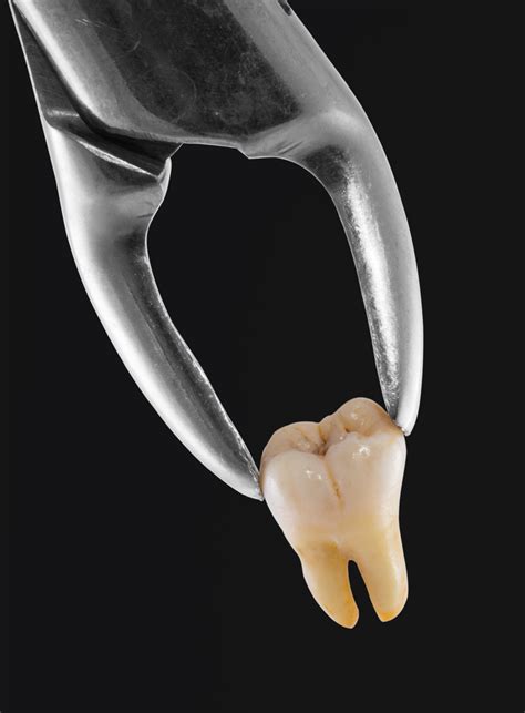 Extracting A Damaged Tooth Is Easier Than You Might Think
