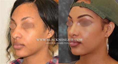 African American Rhinoplasty Los Angeles Black Nose Surgery