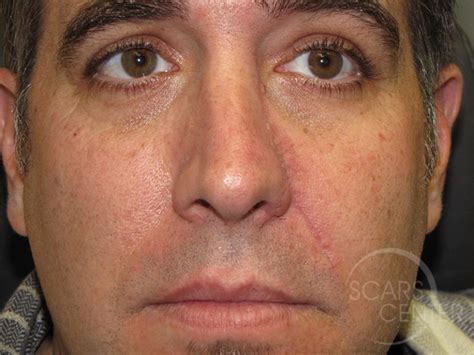 Nose Reconstruction 2 Skin Cancer And Reconstructive