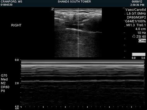 Additionally, it can result in timely diagnoses specifically in neonatal pneumothorax. Ultrasound training Videos Lung » Department of Anesthesiology » College of Medicine ...