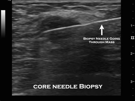 Ultrasound Guided Cyst Aspiration And Minimally Invasive Breast Biopsy