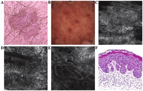 A Clinical Image Illustrated A Well Demarcated Erythematous Scaly