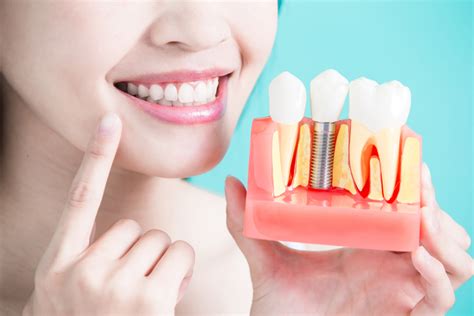 The Basics Of Dental Implants My Dental Remedies