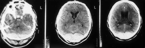 Bilateral Epidural Hematoma Extending From The Posterior Fossa To The Download Scientific