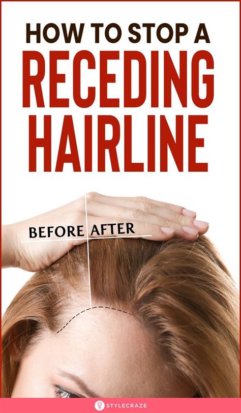 How To Stop Receding Hairline And Regrow Hair Naturally The 2023