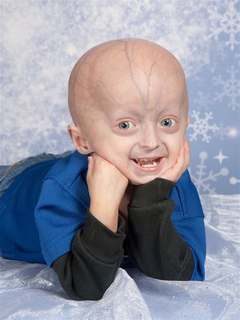 Progeria Disease Rare Diseases In The World
