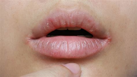 Our Best Tips For Healing Cracked Lip Corners Fast