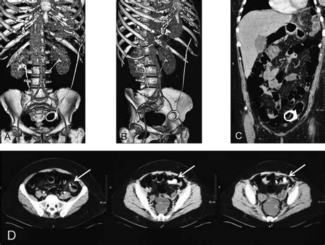 A And B Axial Ct Of The Abdomen With Contrast Revealing The