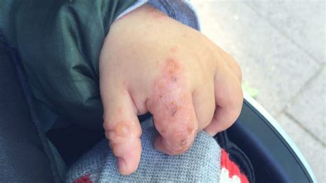 Hand Mund Fuß Krankheit Beim Kind Erkennen Und Behandeln
