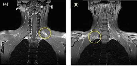 Brachial Plexus Injury Mri