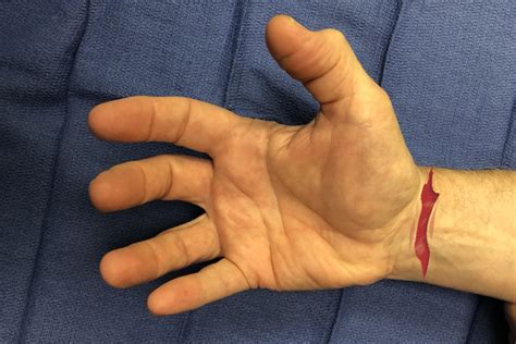 Laceration Open Wound Hand Surgery Resource