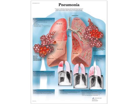 Anatomical Chart Pneumonia A 1 Medical Integration