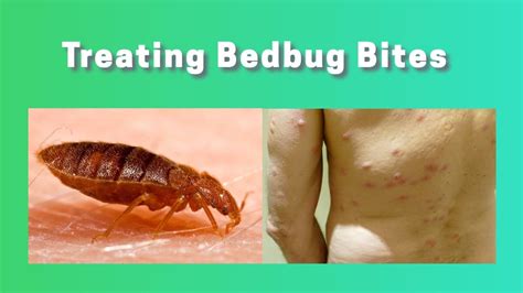 What Do Bed Bug Bites Look Like Symptoms And Treatments Youtube