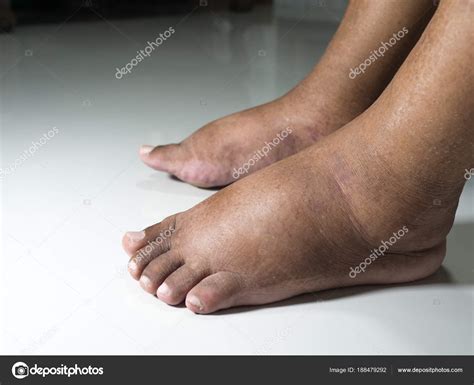 Diabetes Swollen Feet Diabeteswalls