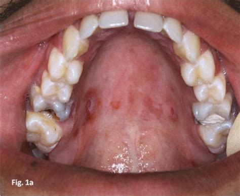 Syphilis Tongue Lesions