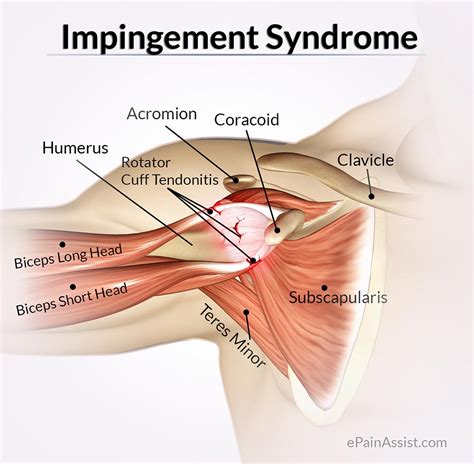 Rotator cuff injury symptoms and signs. Impingement Syndrome: Treatment, Exercise, Home Remedies
