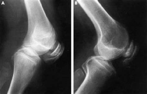 Lateral Knee X Ray Of A Patient 3a At 20 Years And B Patient 5b At