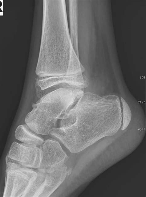 Ankle Fracture Posterior Process Of Talus With Talar Dom Flattening