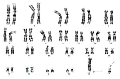 A Karyotype Of The 4 Th Patient With X Chromosome Showing Fragile Site