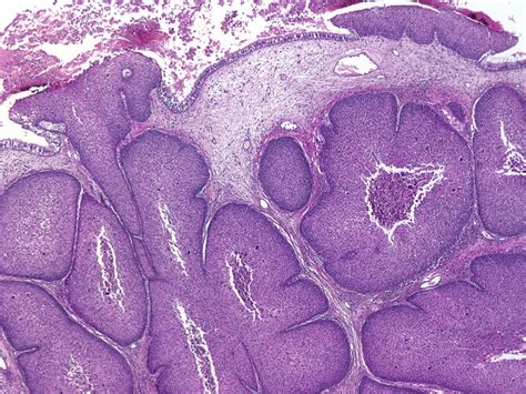 Webpathology A Collection Of Surgical Pathology Images