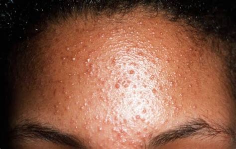 What Is Fungal Acne Pityrosporum Folliculitis Causes And Treatment