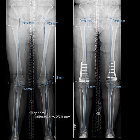 Before And After Photos Old Limb Lengthening