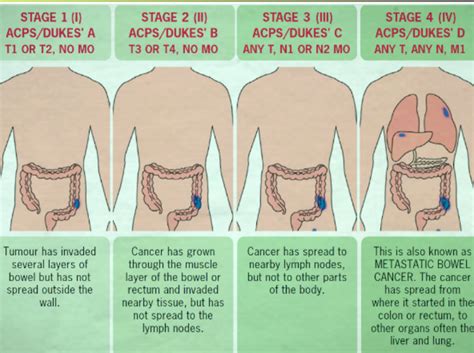 Bowel cancer screening aims to detect bowel cancer at an early stage when there is a good chance that treatment will cure the cancer. Alternative Medicine & Diet - Xhealthx