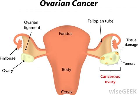 They also went on the say that ovarian cancer groups think that ovarian cancer is more deadly that other cancers. What Are the Different Types of Epithelial Cancer?