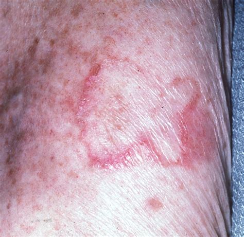 Which Skin Lesion Is Nonraised Discolored Spots Williams Bobtly