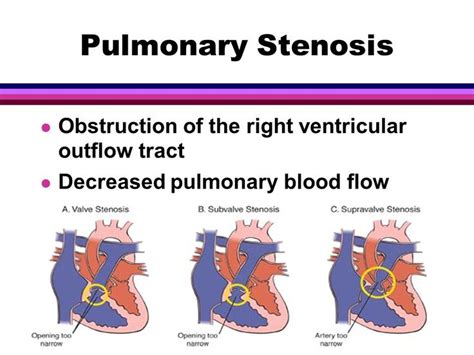 21 Best Right Ventricular Outflow Tract Obstruction Images On Pinterest