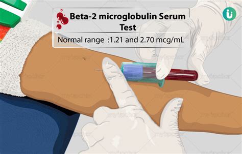 Beta 2 Microglobulin Serum Test Procedure Purpose Results Normal Range Cost Price Online