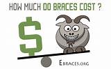 Pictures of How Much Braces Cost With Insurance