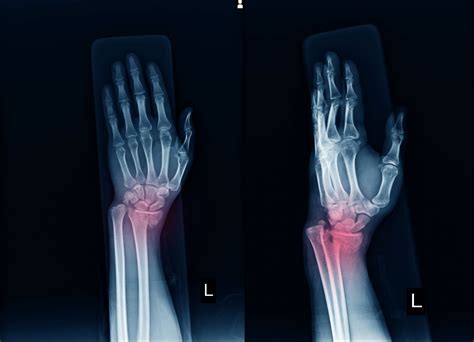 Wrist Fracture Treatment Manchester Hand Wrist Surgery