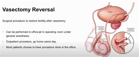 Vasectomy Reversals Just As Successful In Men Over