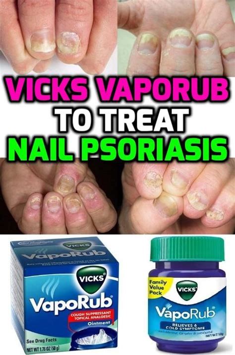 Trim Your Nail Short And Apply A Good Amount Of Vicks Vaporub On The
