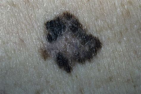 Early Signs Of Skin Cancer Pictures 15 Photos And Images